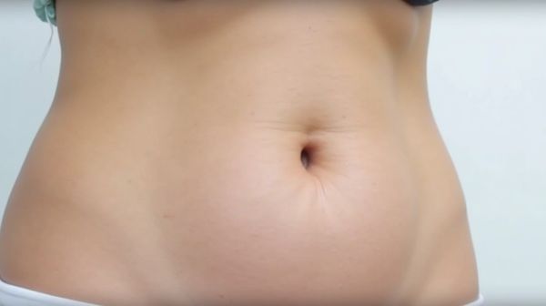 Guide complet sur la cryolipolyse pour réduire la graisse abdominale